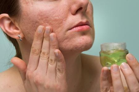 Cómo eliminar el acné con remedios caseros naturales