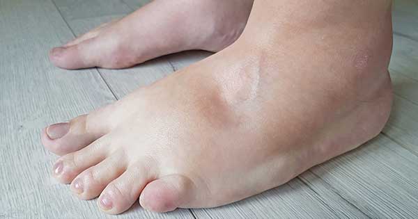 Cómo aliviar la retención de líquidos con métodos naturales y efectivos